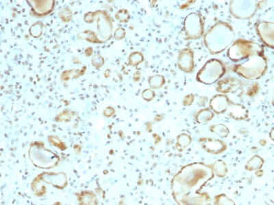 FFPE human renal cell carcinoma sections stained with 100 ul anti-STAT6 (clone STAT6/2410) at 1:400. HIER epitope retrieval prior to staining was performed in 10mM Citrate, pH 6.0.
